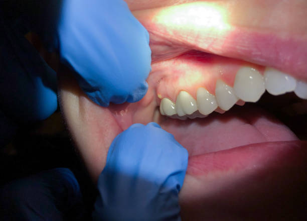 Best Broken Tooth Emergency  in Ladoga, IN